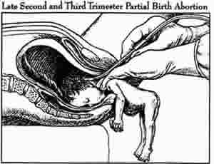 Partial Birth Abortion